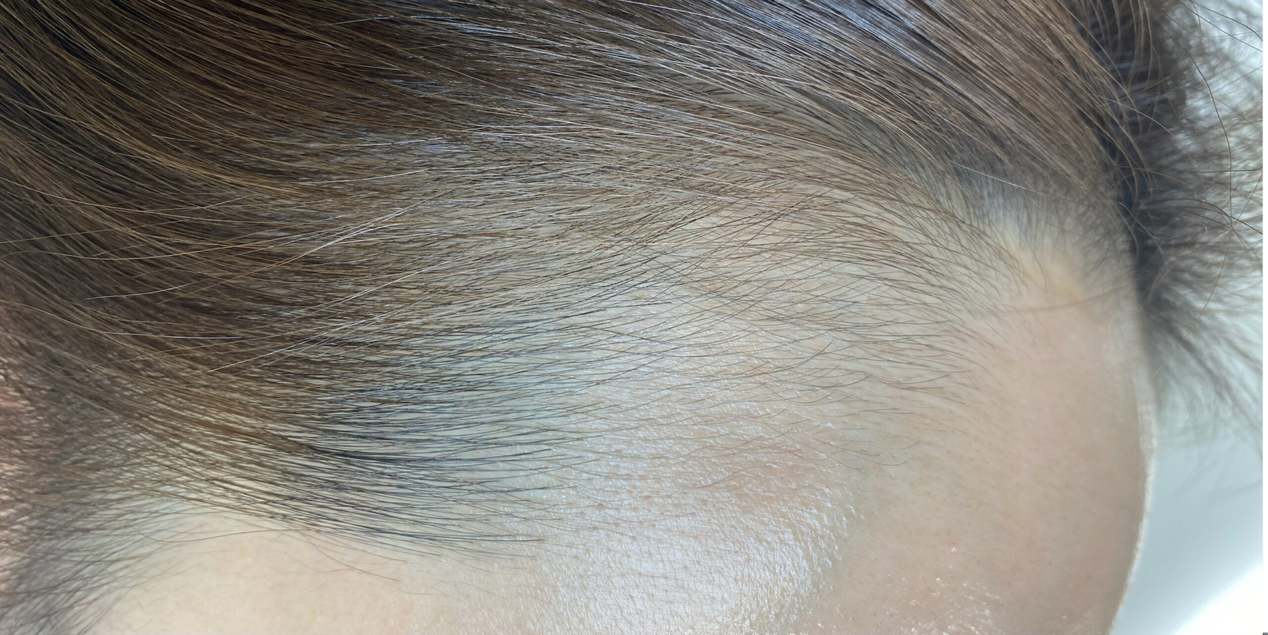 施術前：dawny hair LINE(ヘアラインアートメイク)