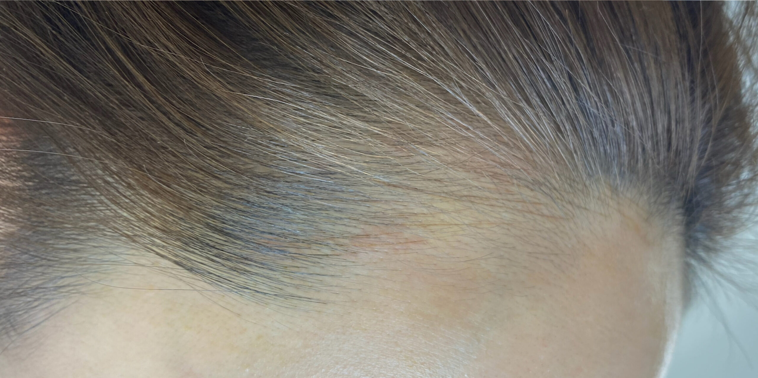 施術後：dawny hair LINE(ヘアラインアートメイク)